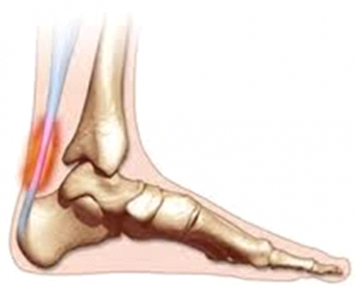 Achilles Tendinopathy / Tendinitis - Qld Orthotics