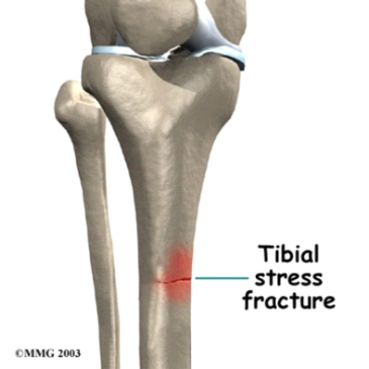 Medial Tibial Stress Fracture Qld Orthotics